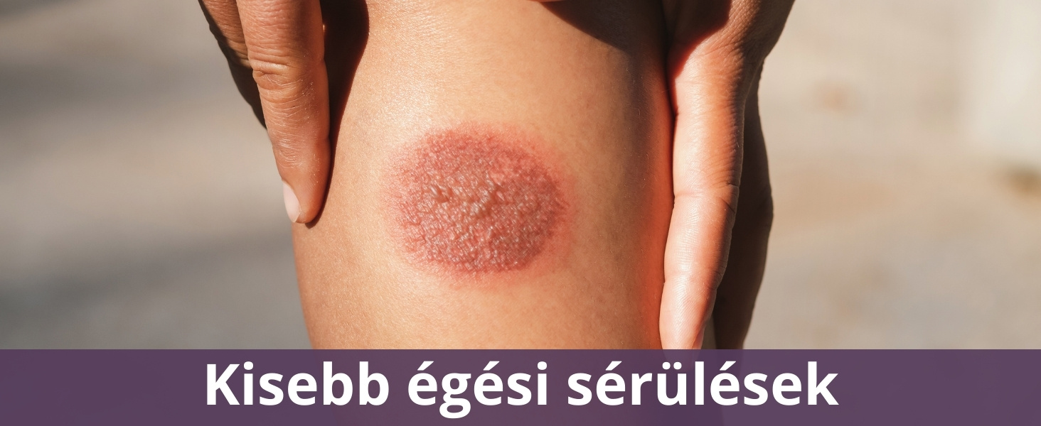 Kisebb égési sérülések